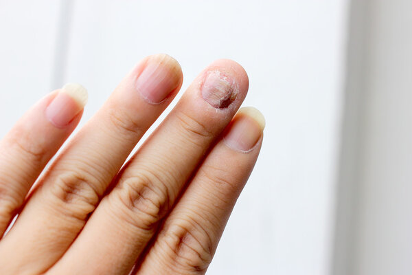 Грибковая инфекция на ладони, палец с онихомикозом. - мягкая направленность
