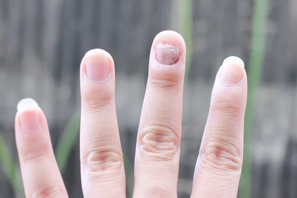 Fungus Infection on Nails Hand, Finger with onychomycosis. - soft focus — Stock Photo, Image