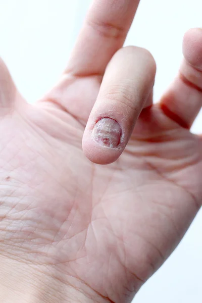 Fungus Infection on Nails Hand, Finger with onychomycosis. - soft focus — Stock Photo, Image