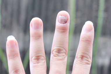 Çivi yandan, parmak Onikomikoz ile mantar enfeksiyonu. -yumuşak odak