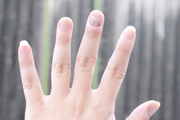 Fungus Infection on Nails Hand, Finger with onychomycosis. - soft focus — Stock Photo, Image