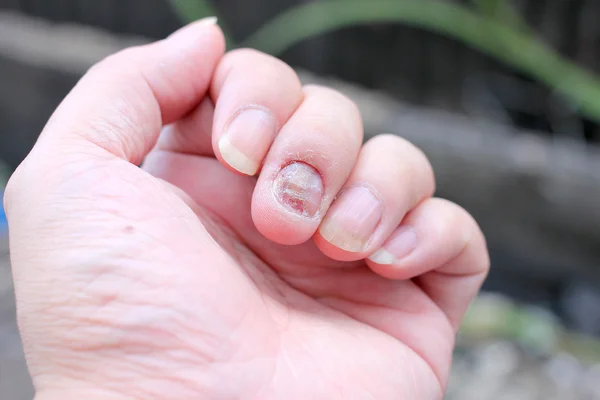 Infekcji grzyba na paznokcie dłoni, palców z grzybica paznokci. -miękka ostrość — Zdjęcie stockowe