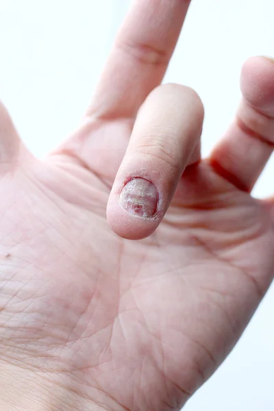 真菌感染对指甲的手，手指与甲真菌病。-软焦点 — 图库照片