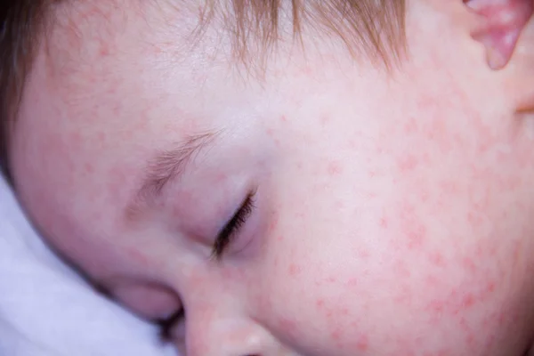 Baby mit Hautausschlag. Allergiker, die unter Nahrungsmittelallergien leiden. Neurodermitis aus nächster Nähe Symptom auf der Haut der Wangen. Allergiekonzept — Stockfoto