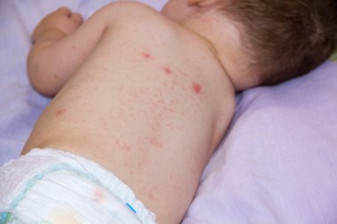 Dermatit döküntü problemini bebekle. Anti döküntü gıda alerji muzdarip. Yakın çekim Atopik dermatit belirti yanakları cilt üzerinde. Anti kavramı