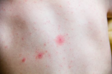 Dermatit döküntü problemini bebekle. Anti döküntü gıda alerji muzdarip. Yakın çekim Atopik dermatit belirti yanakları cilt üzerinde. Anti kavramı