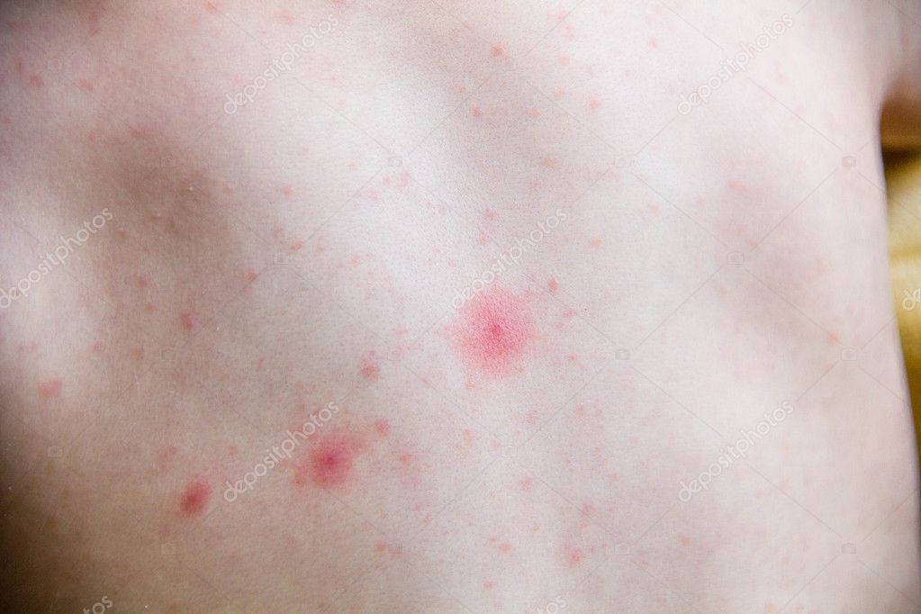 Baby With Dermatitis Problem Of Rash Allergy Rash Suffering From Food Allergies Close Up Atopic Dermatitis Symptom On Skin Of Cheeks Allergy Concept Stock Photo By C Konevaelvira Gmail Com