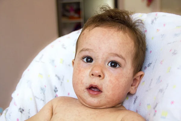 Baby with dermatitis problem of rash. Allergy suffering from food allergies. Close-up atopic symptom on skin cheeks. concept — Stock Photo, Image