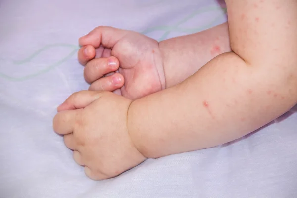 Bebê com problema de dermatite de erupção cutânea. Alergia que sofre de alergias alimentares. Sintoma atópico de perto nas bochechas da pele. conceito — Fotografia de Stock