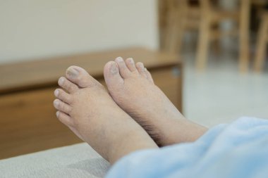 Kanepede dinlenen şişmiş ayakların yakın çekimi, ayaklarda olası bir sağlık sorunu veya rahatsızlık olduğunu gösteren doku ve renklendirmeyi vurguluyor..