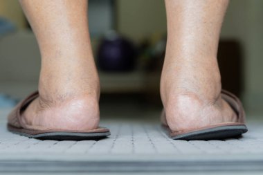 Ayaklarında sert ve kalın deri dokusu olan insan topukları. Yaşlı bir kadının topukları çatlamış. Sağlık ve Tedavi kavramı