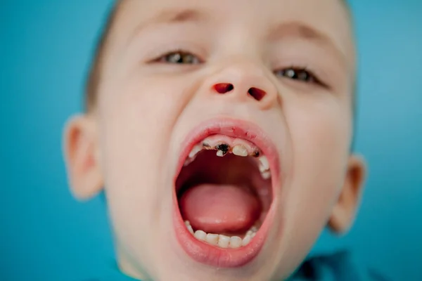 Primer Plano Las Manos Del Dentista Con Asistente Guantes Azules — Foto de Stock