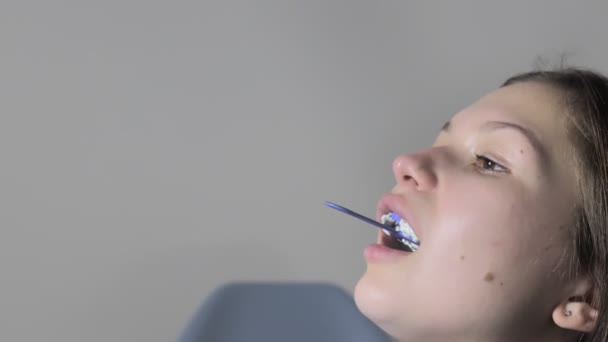 Ortodontista Usando Bandeja Impressão Dentária Dentes Mulher Espátula Dentária Com — Vídeo de Stock