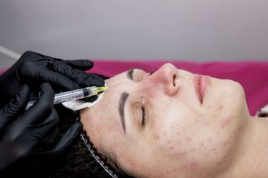 Kozmetik uzmanı kadın derisine hiyalüronik asitle birden fazla enjeksiyon yapıyor, yakın plan. Kadın mesoterapi uygulaması.