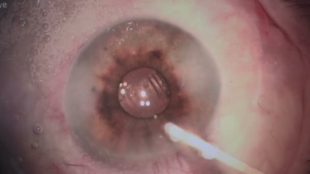 Cirugía ocular. Cirugía de eliminación de cataratas. De cerca. . — Vídeos de Stock