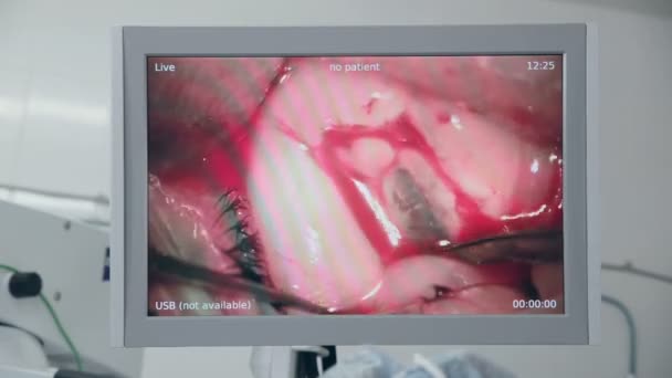 Cirurgia ocular no ecrã dos médicos. Cirurgia de remoção de catarata. Fechar . — Vídeo de Stock