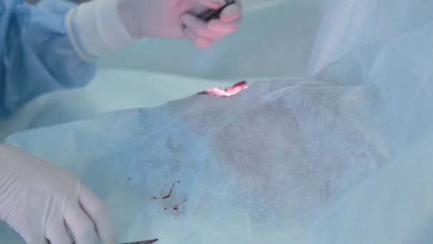 Nära håll händerna i kirurgiska handskar utför kirurgi med hjälp av steriliserad utrustning. — Stockvideo