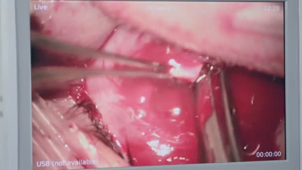 Cirurgia ocular. Terrível perfomance sanguíneo . — Vídeo de Stock