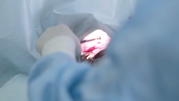 Лікар виконує операцію в операційній залі лікарні . — стокове відео