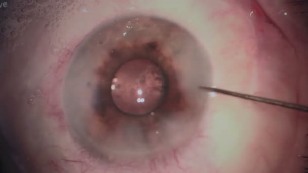 Horrible scène. Chirurgie oculaire. Chirurgie de la cataracte. Gros plan . — Video