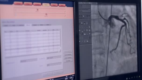 Ultrasonido de un latido del corazón real. Examen ultrasónico en la pantalla del ordenador . — Vídeo de stock