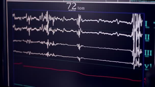 Un vrai cardiogramme. Cardiographe de travail dans un hôpital de cardiologie . — Video