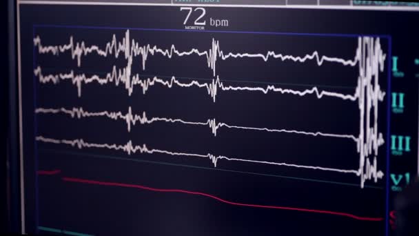 Prawdziwa próba. Kardiograf pracy w szpitalu kardiologia. — Wideo stockowe