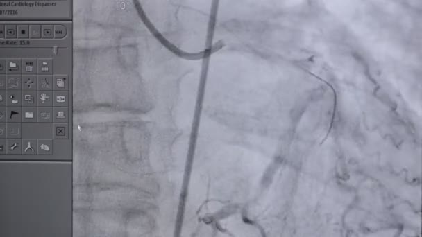 Ultrasonido de un latido del corazón real. Examen ultrasónico en la pantalla del ordenador . — Vídeo de stock