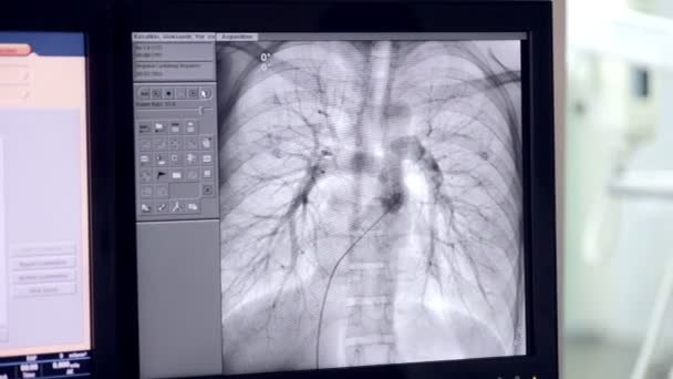 Ultrasonido de un latido del corazón real. Examen ultrasónico en la pantalla del ordenador . — Vídeo de stock