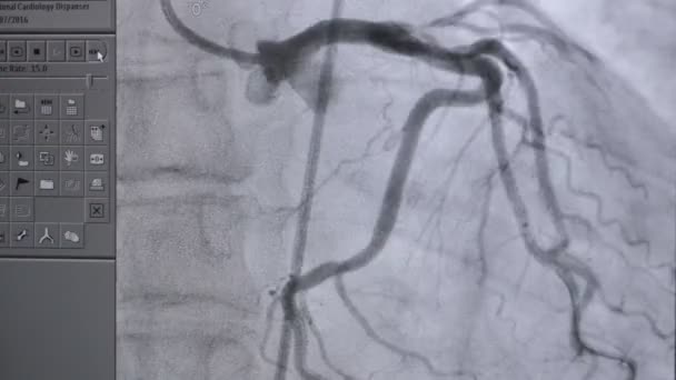 Rayos X latidos del corazón real en acción . — Vídeo de stock