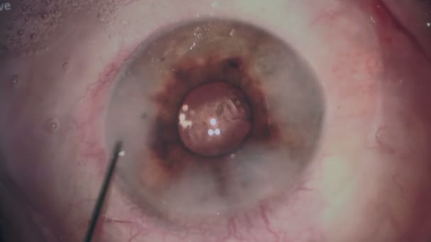 Makroaufnahme der Augen während der Augenoperation. Gruselige Augenoperation. — Stockvideo