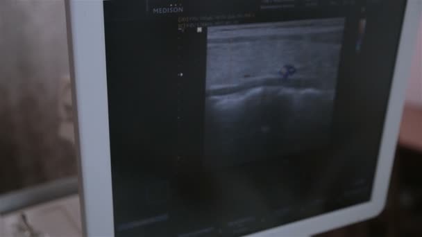 Екрана комп'ютера з щитовидної залози і паращитовидних ультразвук. — стокове відео