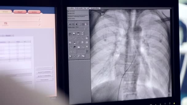 Ultrasound of a Real heartbeat. Ultrasonic examination on computer screen. — Stock Video