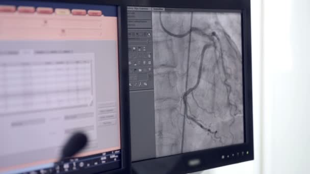 Ultrasuoni di un vero battito cardiaco. Esame ad ultrasuoni sullo schermo del computer . — Video Stock