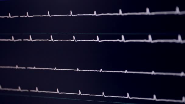 Cardiograma verdadeiro. Cardígrafo de trabalho em um hospital de cardiologia . — Vídeo de Stock