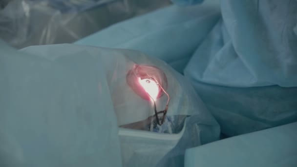 Chirurgien méconnaissable opérant la cataracte oculaire en chirurgie hospitalière . — Video