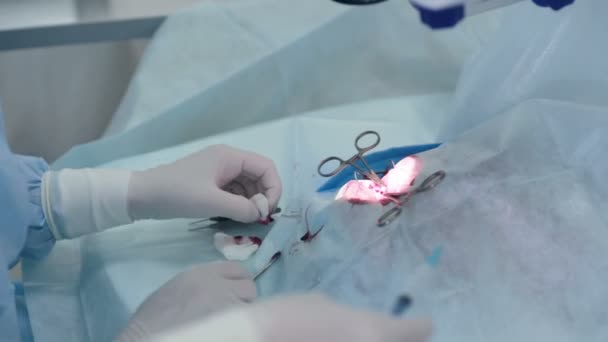 Unrecognizable Surgeon operating eye cataract in hospital surgery. — Stock Video