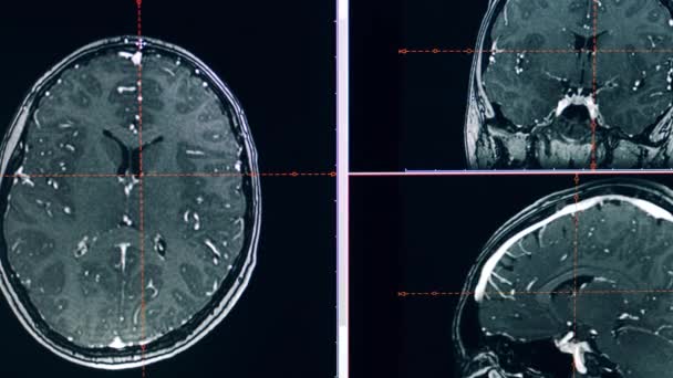 환자의 뇌에 대한 MRI 스캔이 연구되고 있습니다. — 비디오