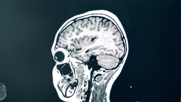 Σάρωση εγκεφάλου κατά τη διάρκεια μιας διαδικασίας MRI — Αρχείο Βίντεο