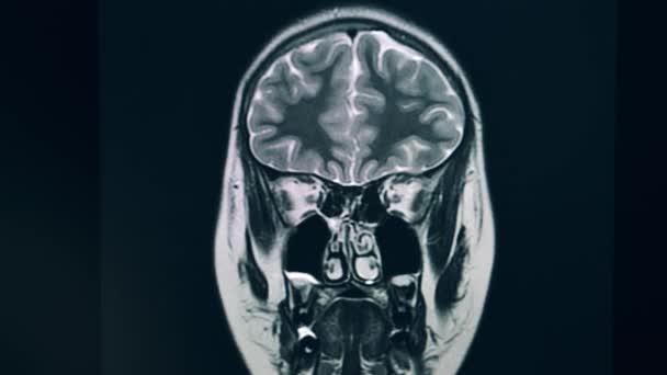 Patiënten hoofd tijdens magnetische resonantie tomografie — Stockvideo