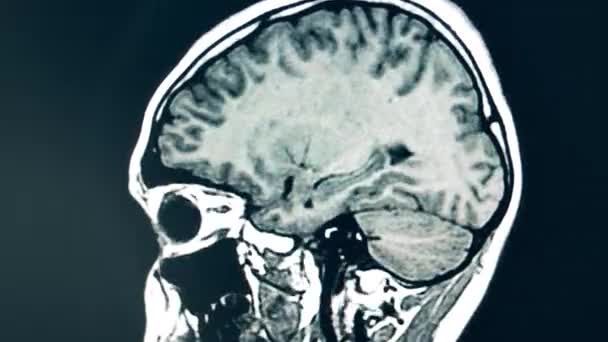 Dynamisch beeld van het menselijk brein tijdens CT-scan — Stockvideo