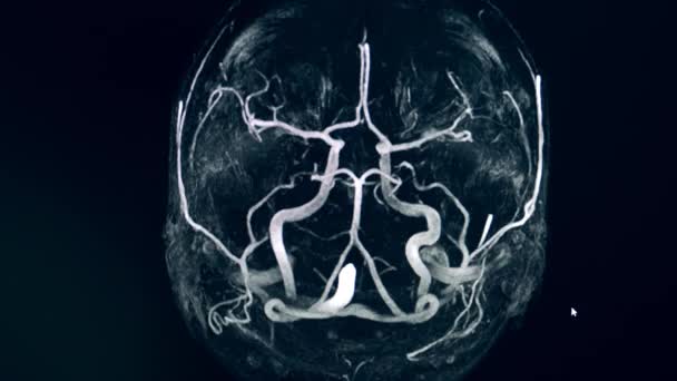 Dynamisk CT bild av en hjärna arteriell cirkel — Stockvideo