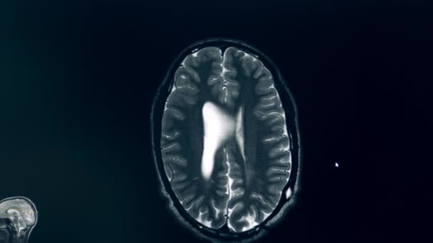 Imagen computarizada de un cerebro durante el procedimiento de resonancia magnética — Vídeos de Stock