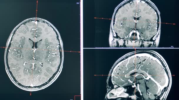 Tomografia komputerowa mózgu człowieka w dynamice — Wideo stockowe