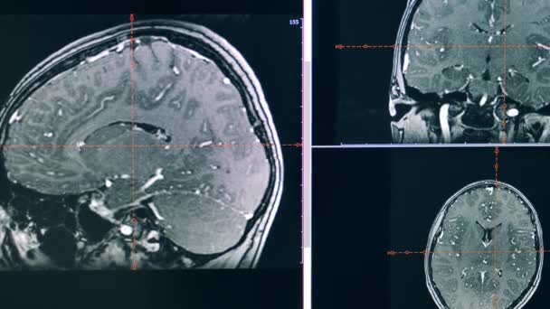 CT scan otak pada tampilan komputer — Stok Video