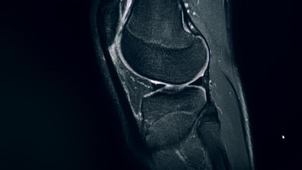 Na rezonansie magnetycznym widać kości kolanowe. — Wideo stockowe