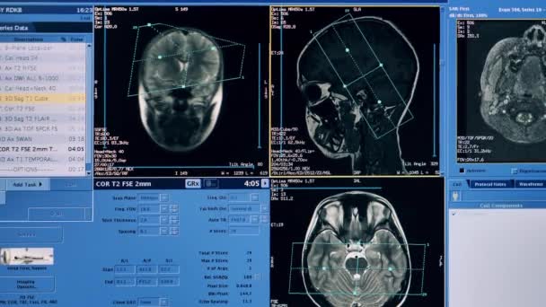 Interface de computador mostrando imagens de TC de um cérebro — Vídeo de Stock