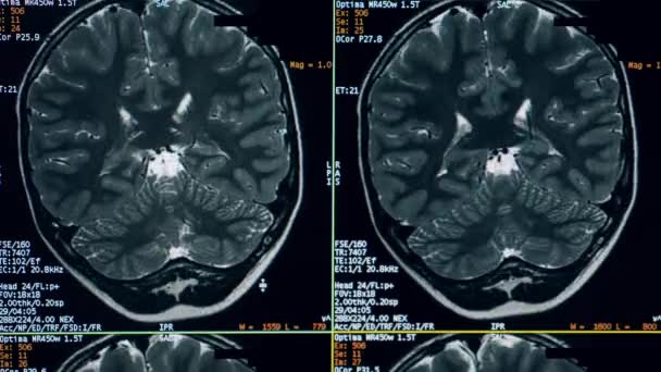 Dynamische CT-Bilder eines Gehirns auf dem Computerbildschirm — Stockvideo