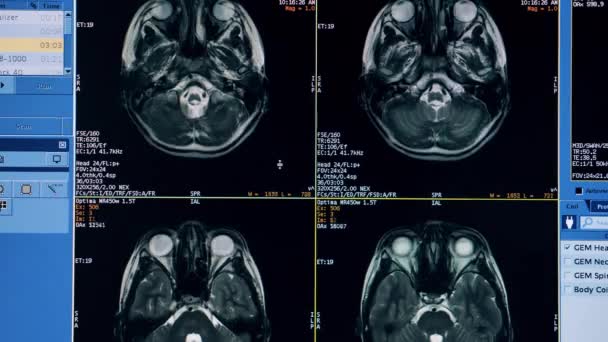 Meerdere CT-beelden van een hersenshow door een computerprogramma — Stockvideo