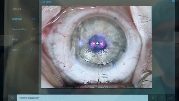 Närbild av patienter öga under laserkorrigering — Stockvideo